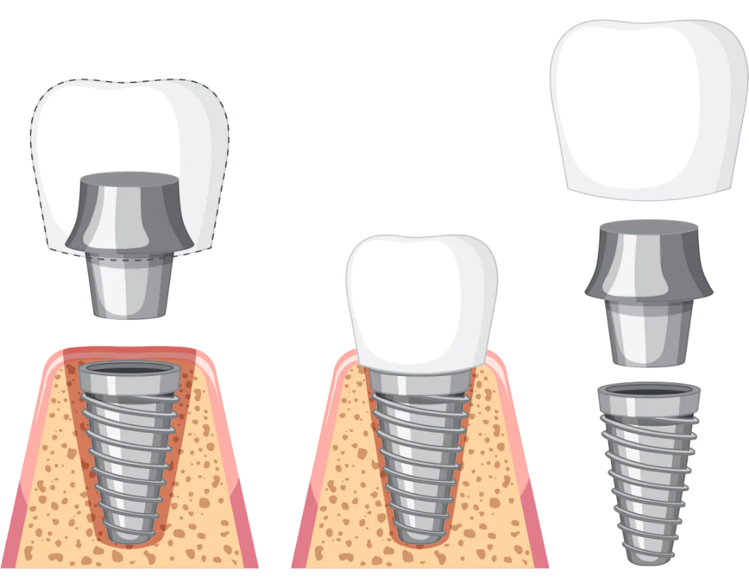 IMPLANTY ZĘBOWE / IMPLANTOLOGIA / braki zębowe