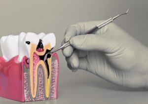 Ząb mądrości stan zapalny, dentysta Chorzów